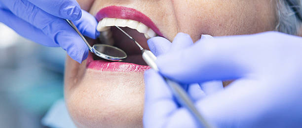 Best Emergency Dental Care for Broken or Chipped Teeth in Huxley, IA